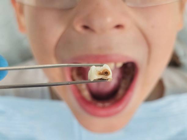Best Emergency Tooth Extraction in Summerfield, NC